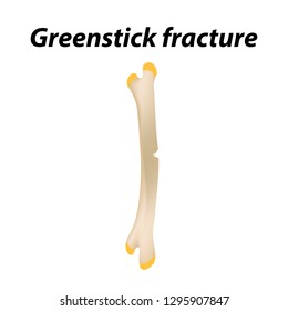 Greenstick fracture Bone. Infographics. Vector illustration on a lined background.