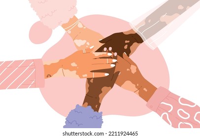 Group of vitiligo people with different skin colors putting hands together. Vitiligo skin concept. Skin disorder, self-acceptance, emotional support. Cartoon vector illustration. Isolated background