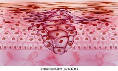 Growing Tumor, Tissue Section Inflamed Skin - Vector Illustration