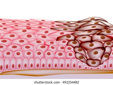 Growing Tumor, Tissue Section - Vector Illustration 