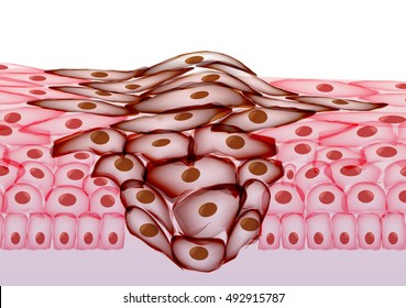 Growing Tumor, Tissue Section - Vector Illustration 