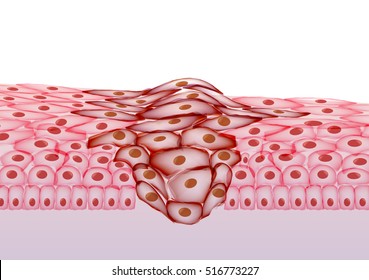 Growing Tumor, Tissue Section - Vector Illustration