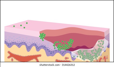 Growth Of A Bacterial Biofilm On A Skin Wound, From Initial Attachment Through Microcolony Formation, Signalling And Mature Biofilm