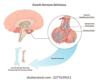 Growth hormone deficiency. Syndrome characterized by insufficient secretion of growth hormone, hypophyseal pituitary gland work congenital or acquired pathology. Flat vector illustration