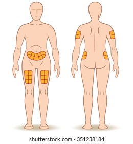 Guide for application of a caster injection into a person, back, thigh, shoulder, belly, and may be for the treatment of diabetes or sclerosis