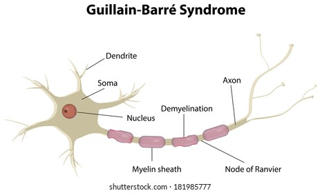 Guillain Barre Syndrome High Res Stock Images Shutterstock