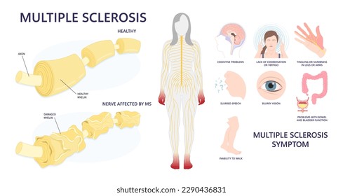 Zeichen und Symptom des Multiplen Sklerose-Syndroms mit Neuronenzellen, die in der Medizin beschädigt sind