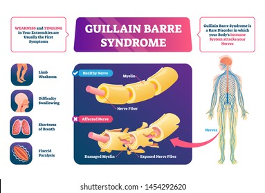 Guillain Barre Syndrome Vector Illustration. Labeled Nerve Disease Scheme. Autoimmune Illness With Muscle Weakness And Tingling Symptoms. Educational Anatomical Healthy And Affected Closeup Structure.