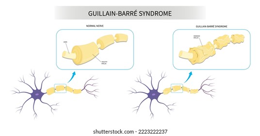 Guillain Barré syndrome limb muscle autonomic numbness tingling disease demyelinating system COVID 19 virus infection pain feet hand arm dysfunction lupus lateral Acute sclerosis stroke bell's palsy