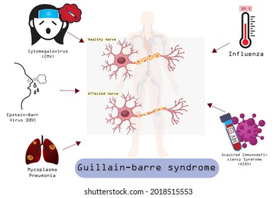 Guillain-Barre (gee-YAH-buh-RAY) syndrome is a rare disorder in which your body's immune system attacks your nerves.