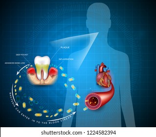 Gum disease inflammation bacteria can enter in to the blood stream an affect heart.  Periodontitis disease disease anatomy on an abstract blue background