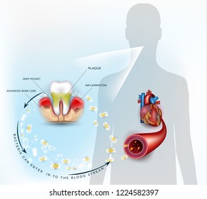 Gum disease inflammation bacteria can enter in to the blood stream an affect heart.  Periodontitis disease disease anatomy