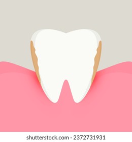 Gum disease. Periodontal disease. Tooth