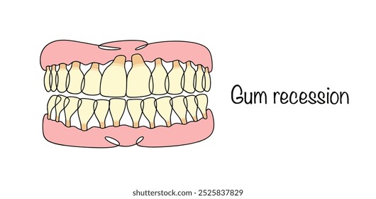 Gum recession. A progressive disease that results in receding gums and exposed tooth roots. Human jaws with exposed tooth roots. Medical color vector. 