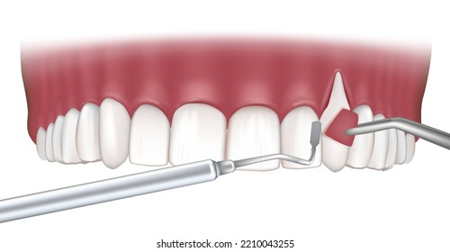 Tratamientos De Recesión De Goma. Cirugía de injerto de tejido blando en la encía. Ilustración del concepto dental. Enfermedad periodontal