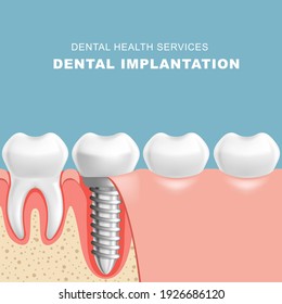 Gum section with dental implantat - row of teeth