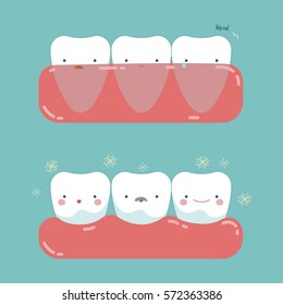 Gum surgery for nice teeth of dental