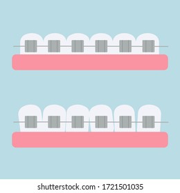 Gum, teeths with metallic braces isolated stock vector illustration. Graphic bright clipart, dental, orthodontic concept. Healthcare and medicine beauty.