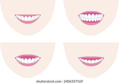 Gummi lächelt, wo die Zahnfleisch zeigen, wenn man lächelt. Vektorgrafik wie Lächeln und Zähne aussehen