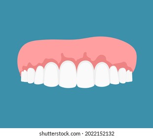 Gums Disease Dentistry Flat Vector Concept Stock Vector (Royalty Free ...