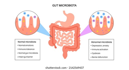 Gut brain connection, dysbiosis and microbiome. Normal and abnormal microbiota. Enteric nervous system, intestine anatomy. Signals from brain to digestive tract. Colon and cerebrum vector illustration