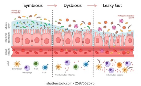 gut health progression from symbiosis to dysbiosis and leaky gut, showing microbiota changes, inflammation, and intestinal permeability diagram hand drawn vector illustration. Medical science