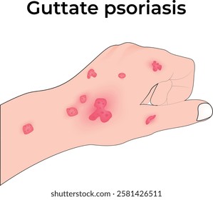 Guttate Psoriasis on Hand Design Vector Illustration