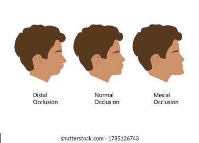 Guy with Distal, Normal, and Mesial bite profile, vector illustration. Overbite or underbite before and after orthodontic treatment. Human with malocclusion, bite correction by braces concept.