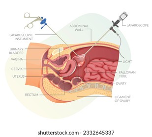 Cirugía ginecológica de Laparoscopía de Agujeros Clave - Ilustración de Existencias como archivo EPS 10