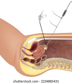 Gynaecological Laparoscopy procedure. Laparoscopic instruments. Hysteroscopy Surgery. Fertilization by extracting eggs.