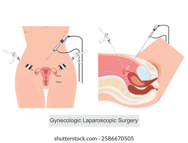 Gynecologic Laparoscopic Surgery is a minimally invasive surgical procedure used to diagnose and treat conditions related to the female reproductive system.medical health care vector illustration.