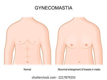 Gynecomastia. comparison and difference between normal breast and Abnormal enlargement of breasts in males. Human chest in front view. hormone imbalance between estrogens and androgens. Vector poster.