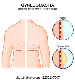 Gynecomastia. hormone imbalance between estrogens and androgens