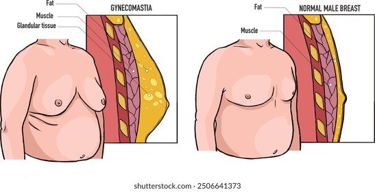 Ginecomastia Hombre Obesidad con tejido graso en el pecho en comparación con el trastorno normal en la medicina