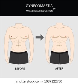 gynecomastia surgery for male breast  in front view