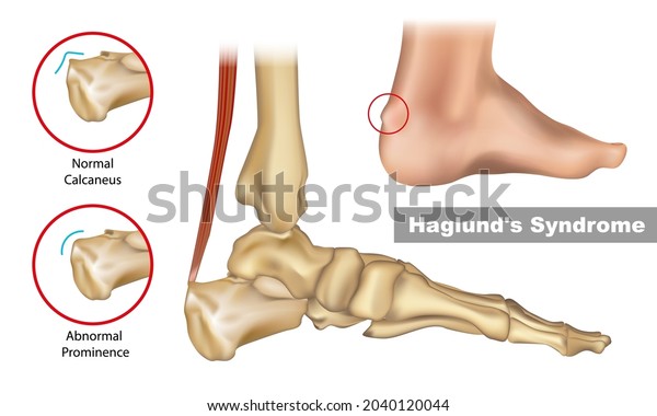 exostosis on top of foot