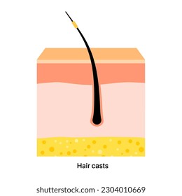 Hair casts problem. Head disease concept. Shafts of the human scalp. Skin layers diagram, epidermis, dermis and hypodermis, subcutaneous fat, medical poster flat vector illustration.