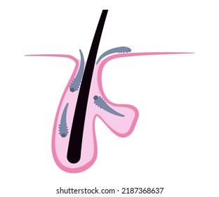 Hair follicle full of demodex mites, simple flat chart. Medical illustration