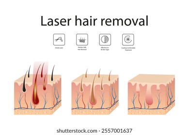 Hair follicle laser examination. Laser hair removal procedure. Step-by-step hair removal method