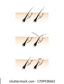 Crecimiento del cabello después de afeitarse y depilarse. Inflamación de la piel del cabello. Ilustración del tratamiento folicular del pelo. Ilustración gráfica del vector