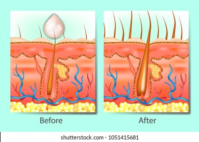 Hair Growth Stimulants Before After. Hair On Scalp Before And After Of Treatment Hair Loss.