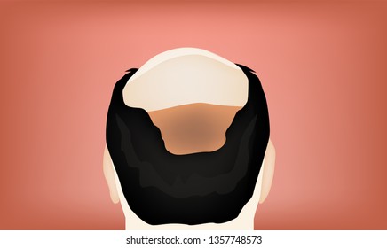 Hair loss in Asia man : bald man in back side