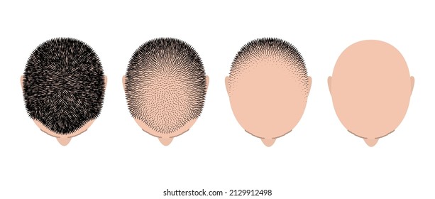 Hair Loss Bald Head Alopecia Transplant Growth Vector Top View. Hair Loss Men Top View Alopecia Scalp Problem