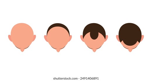 Hair loss bald head alopecia transplant growth vector top view. Hair loss men top view alopecia scalp problem