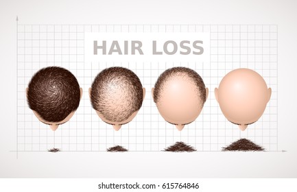 Hair loss. Graph of four stages of alopecia. Eps8. RGB Global colors