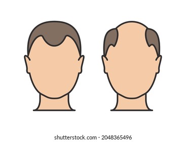 Hair loss man icon cartoon vector logo. Hair loss male scalp bald illustration