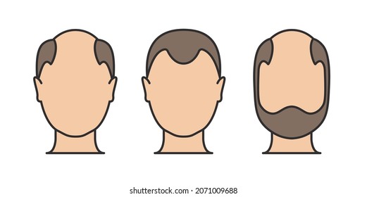 Hair loss man icon cartoon vector logo. Hair loss male scalp bald illustration