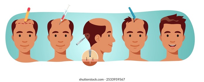 Hair loss problem transplantation treatment steps. Stages of transplanting follicles to man bald head scalp. Alopecia, baldness, FUE procedure progress, person health flat vector illustration set