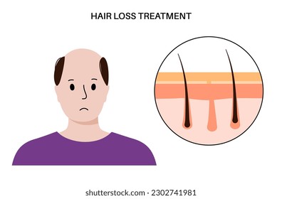 Hair loss problems and treatment. Cartoon man character with balding head. Skin layers diagram, epidermis and dermis medical poster. Androgenetic alopecia, male pattern baldness vector illustration