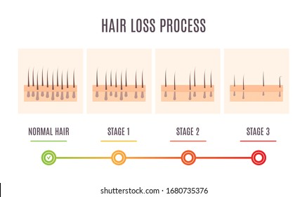 Hair loss process infographic of scalp close up with receding hair follicles. Skin cross-section medical diagnostics diagram. Alopecia treatment and transplantation concept. Vector illustration.